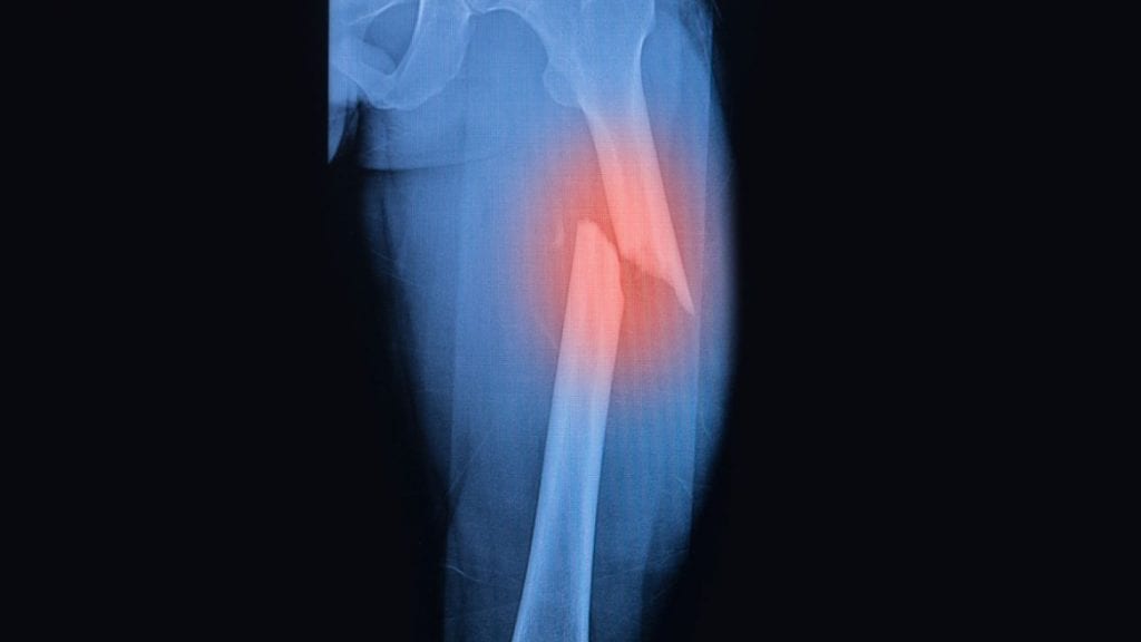 broken bones x-ray